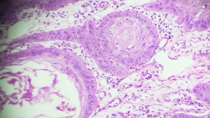 Akcigerde Skuamoz Hucreli Karsinom Nedir
