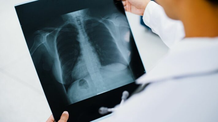 Traksiyon Bronsektazisi Belirtileri Nedenleri ve Tedavisi